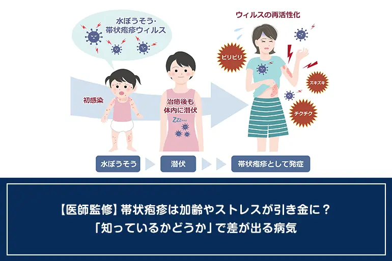 【医師監修】帯状疱疹は加齢やストレスが引き金に？「知っているかどうか」で差が出る病気のイメージ