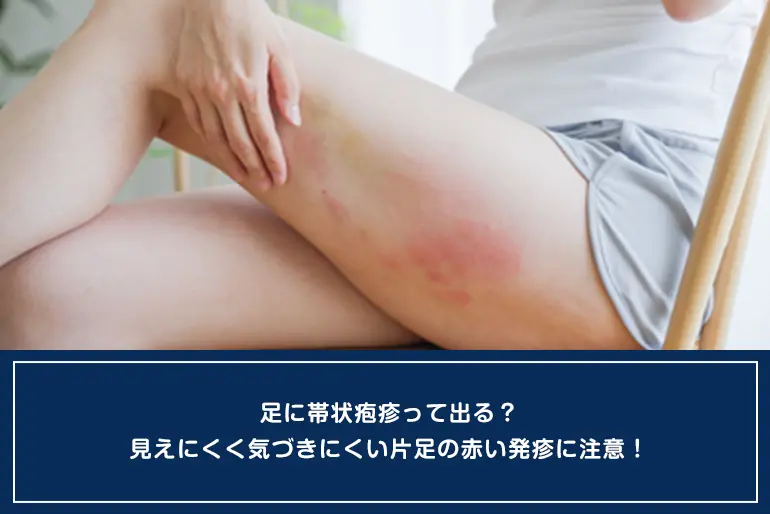 足に帯状疱疹って出る？見えにくく気づきにくい片足の赤い発疹に注意！のイメージ