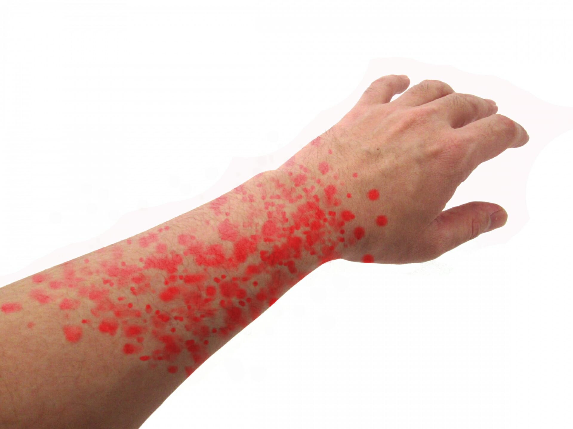 疱疹状皮膚炎の長期的な見通しはどうなりますか?