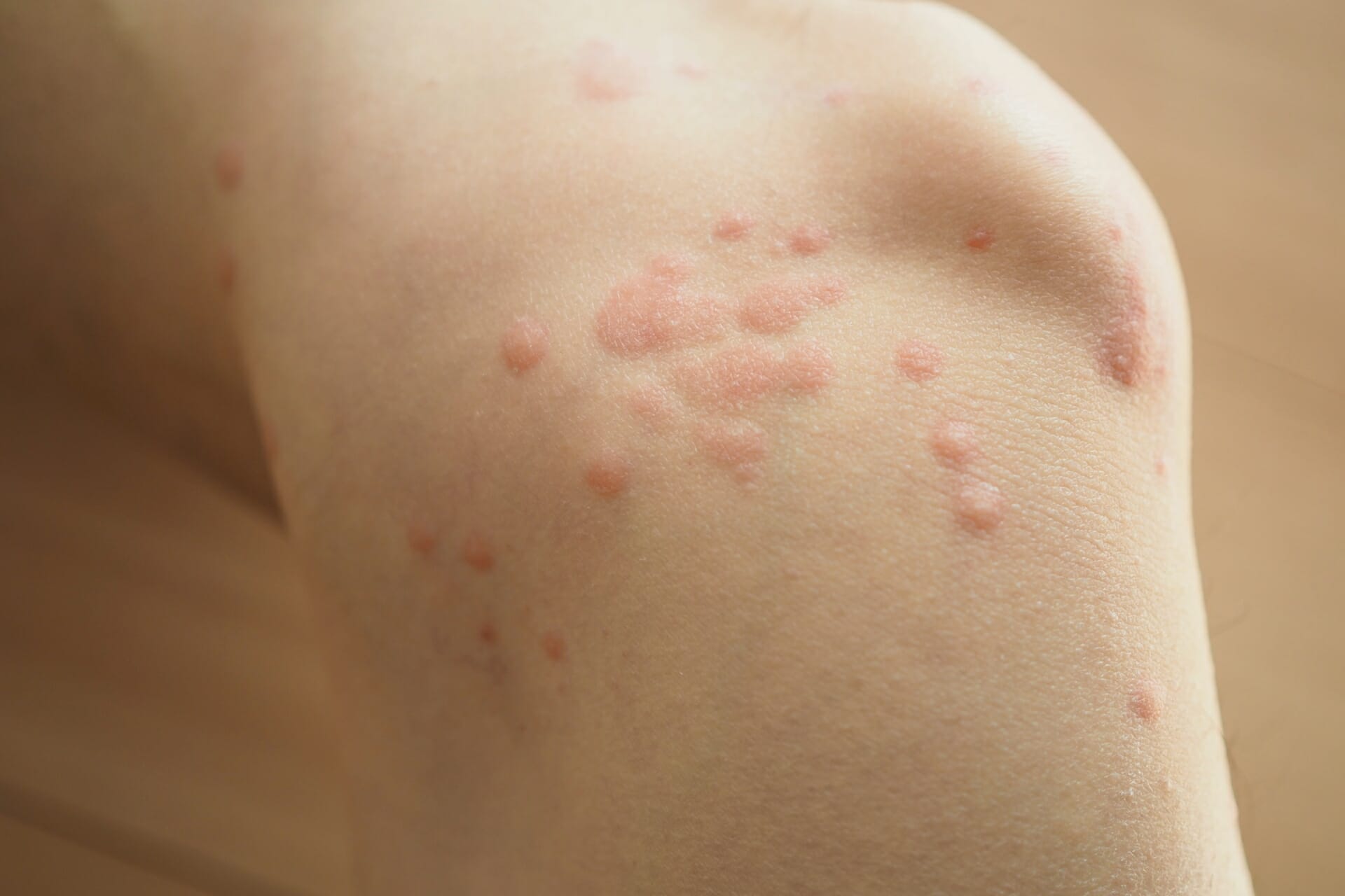 帯状疱疹と蕁麻疹の原因と引き金