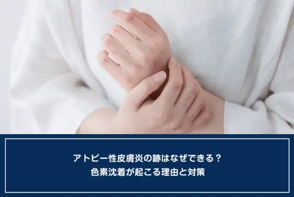 アトピー性皮膚炎の跡はなぜできる？色素沈着が起こる理由と対策のイメージ