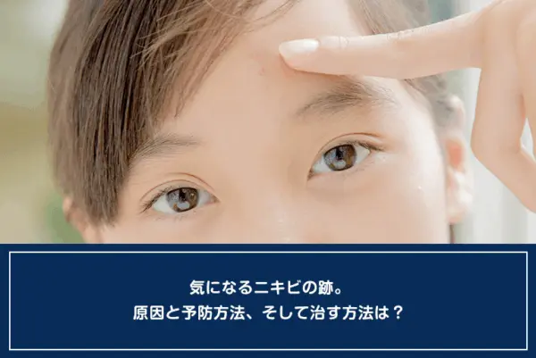 気になるニキビの跡。原因と予防方法、そして治す方法は？のイメージ